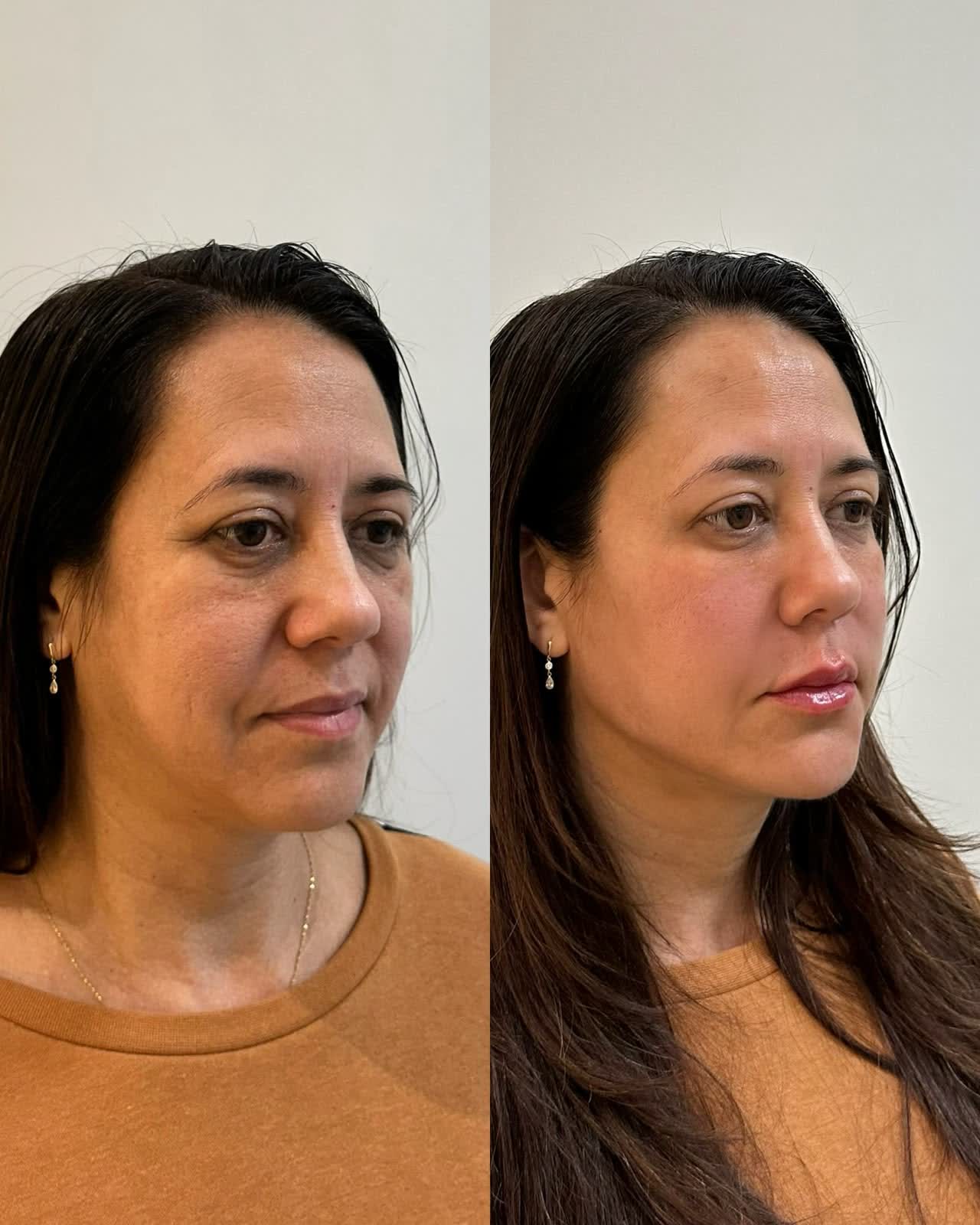 Full Face antes e depois — rejuvenescimento do olhar e contorno mandibular