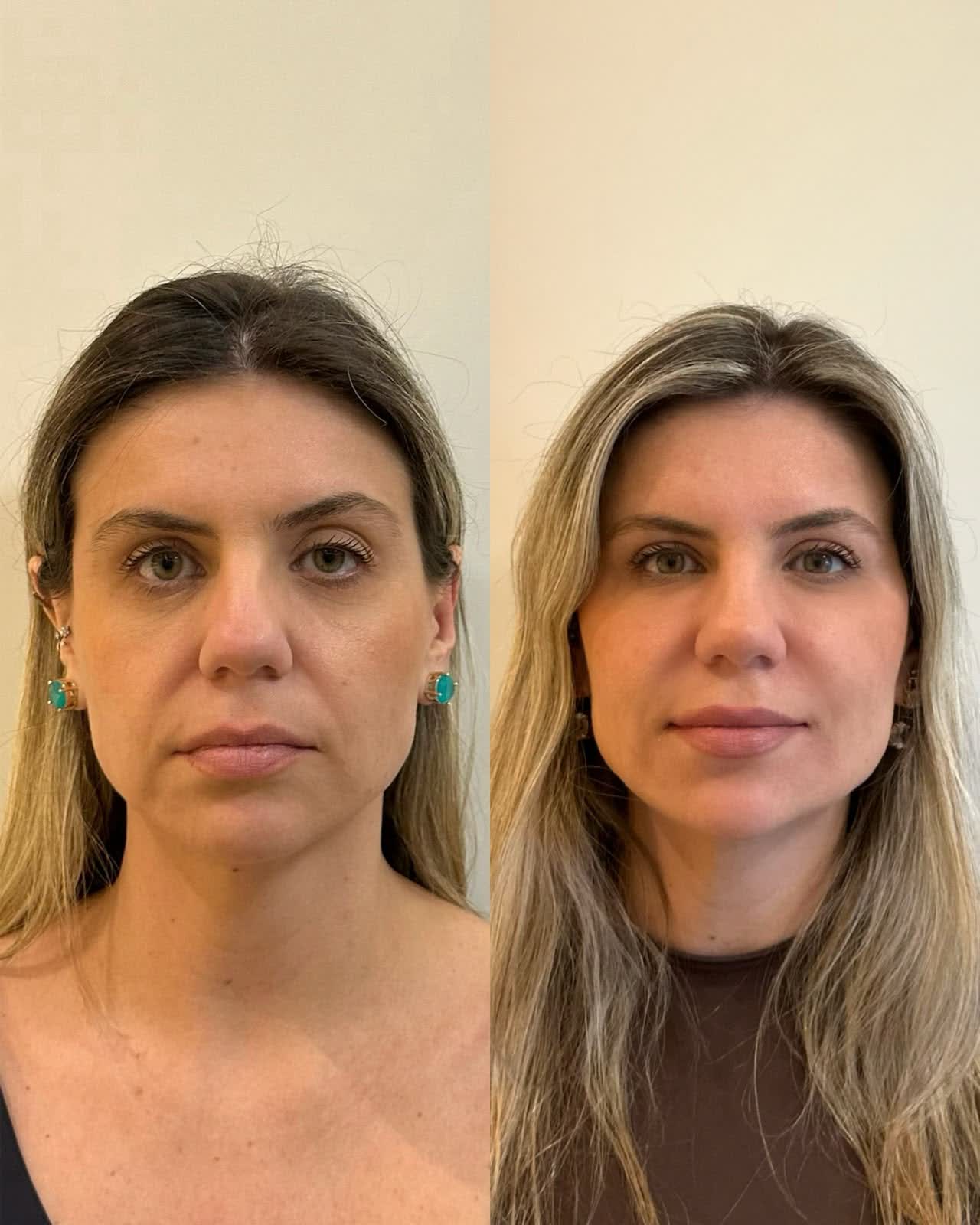 Full Face antes e depois — preenchimento de olheiras e definição facial
