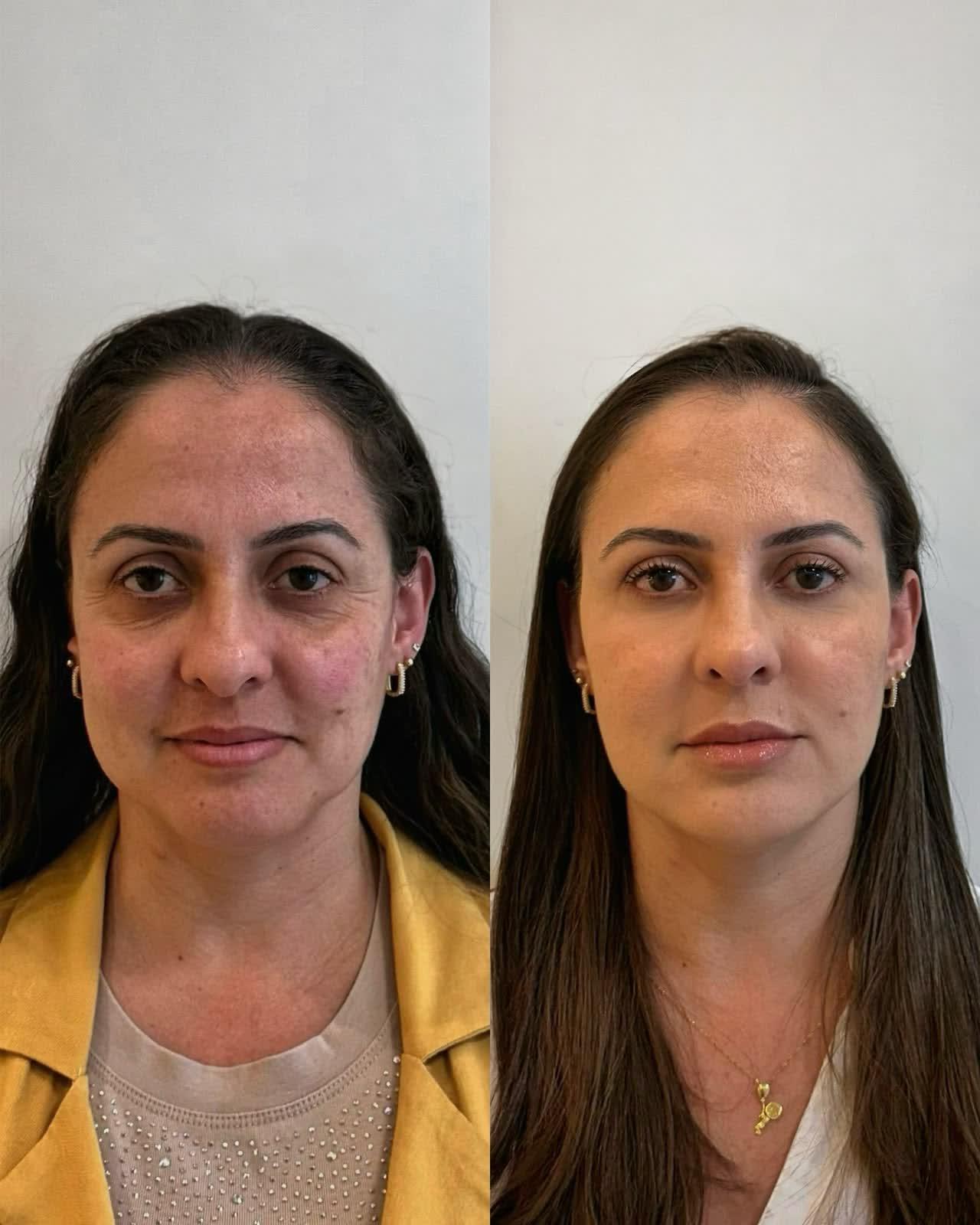 Full Face antes e depois — harmonização facial com resultado natural