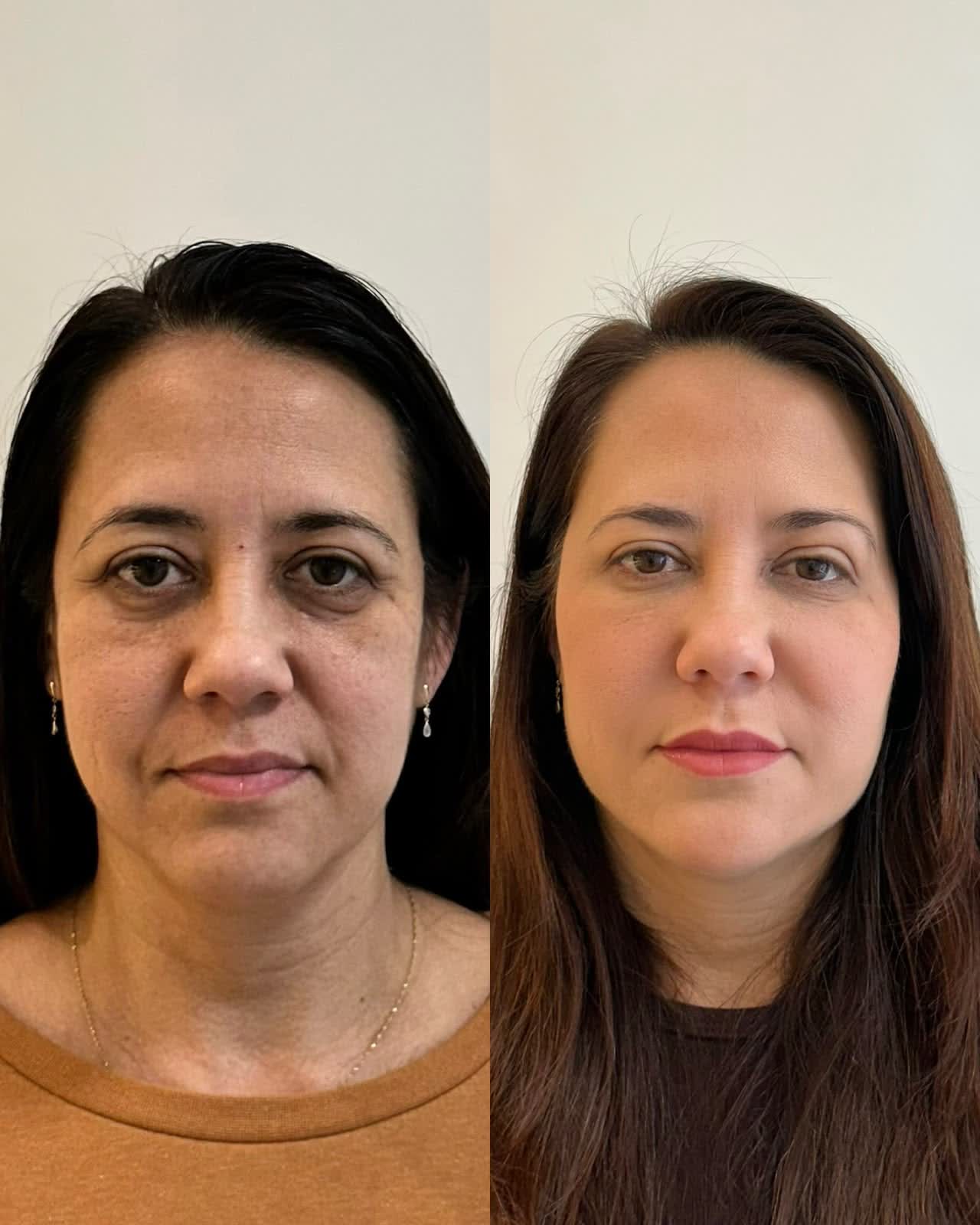 Full Face antes e depois — perfil harmonizado, projeção de mento e mandíbula