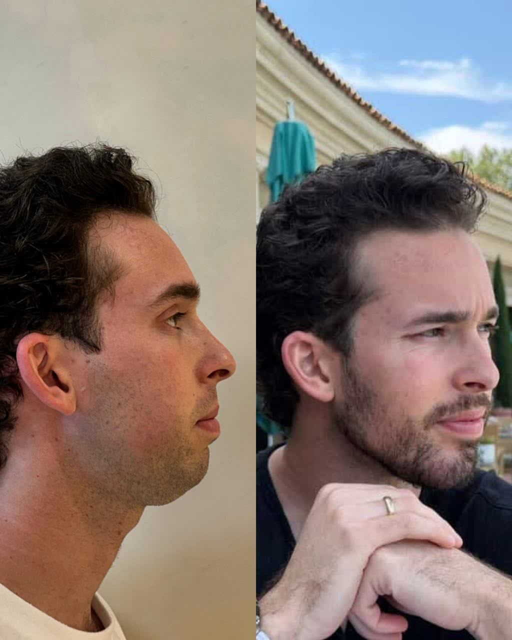 Harmonização facial masculina antes e depois — perfil, Dra. Mikaelly Cardoso
