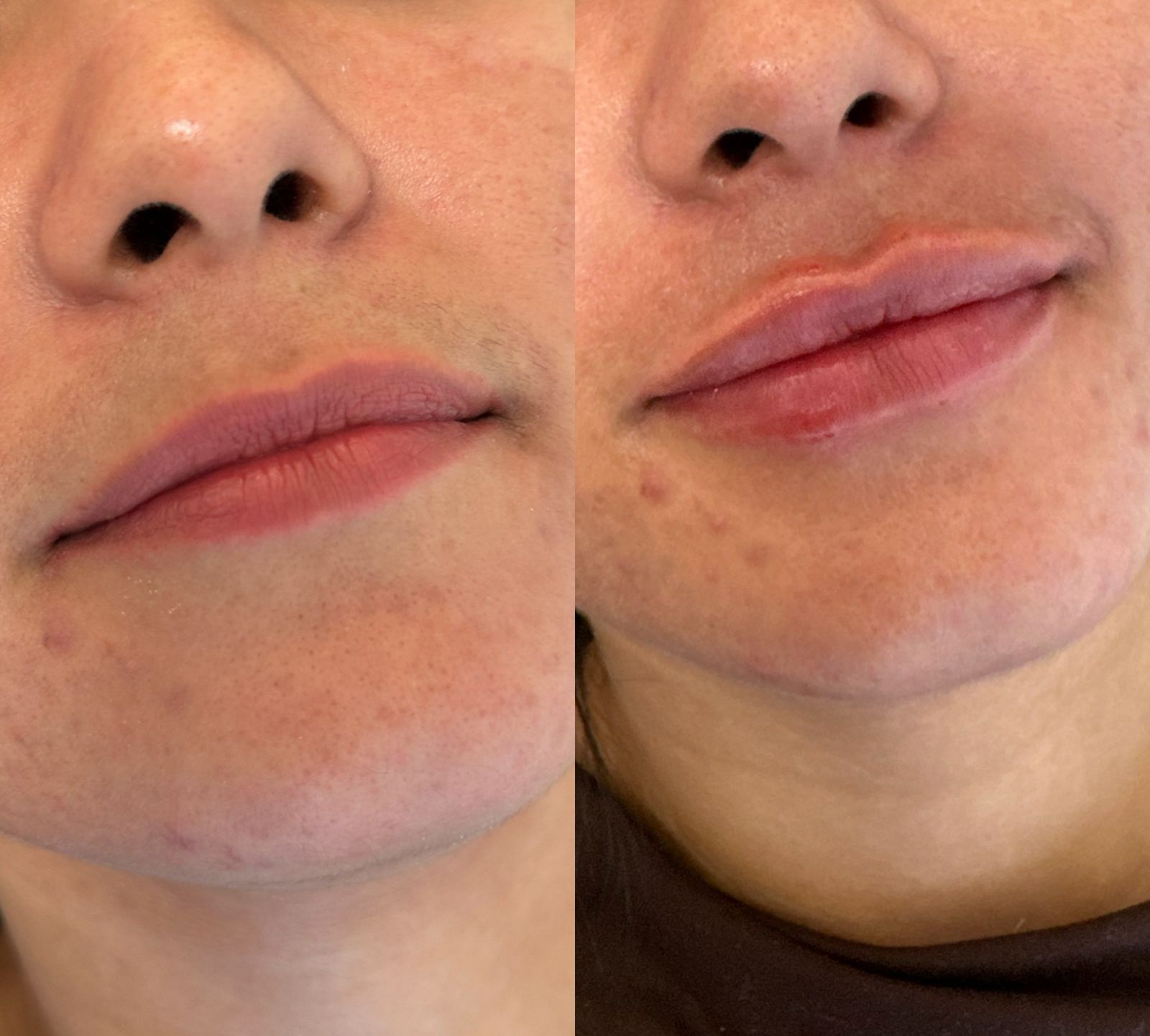 Preenchimento Labial