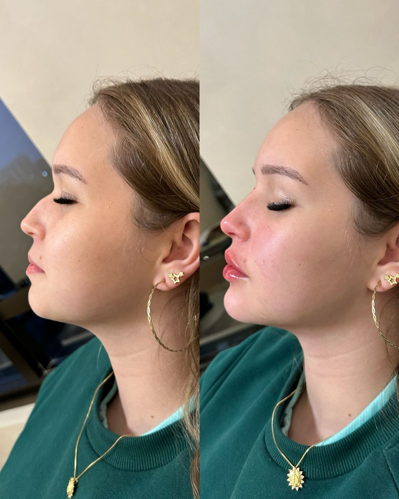 Perfiloplastia
